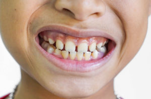 young boy with gaps in his teeth